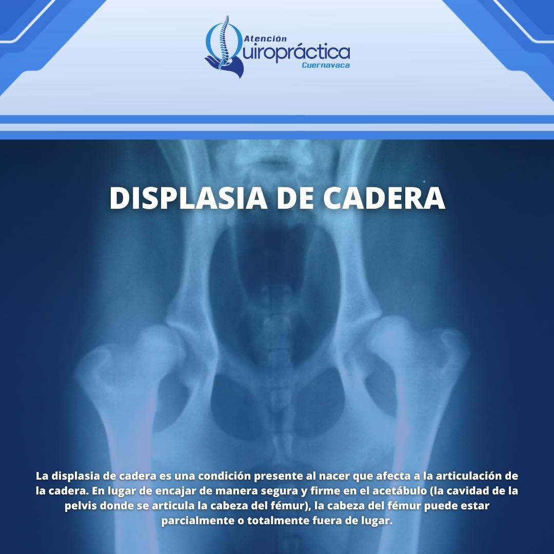 Displasia de cadera