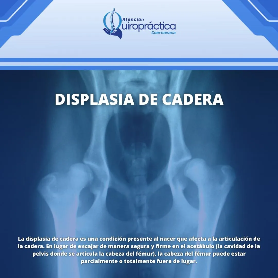 Contenido educativo sobre displasia de cadera